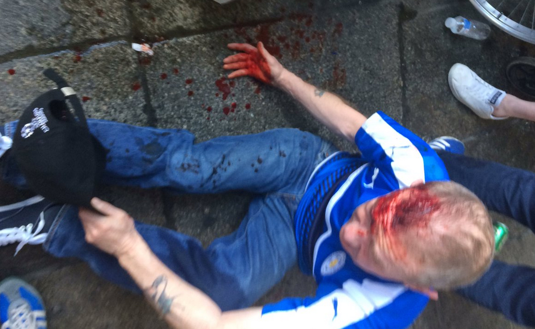 Leicester City Fan After Clash